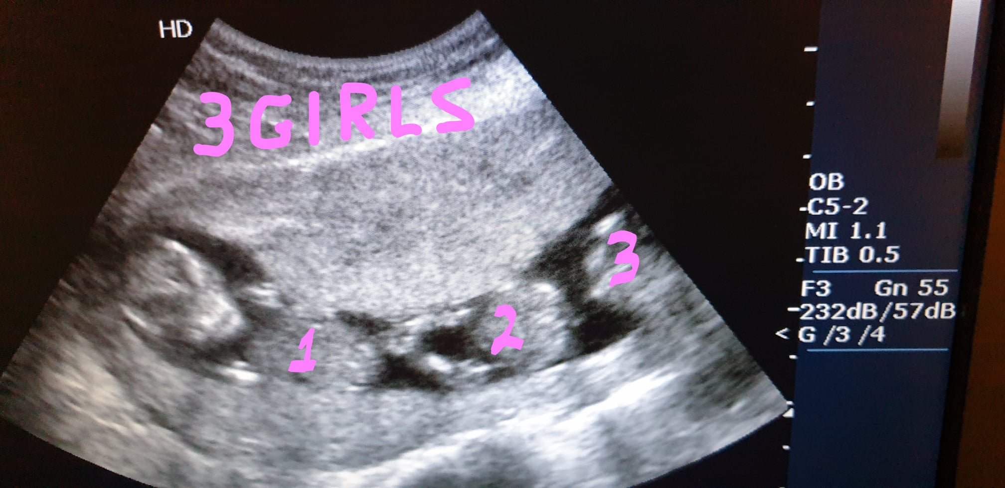 Αληθινή ιστορία Ελληνίδας εγκύου σε τρίδυμα - Πώς τα 2 έμβρυα που της εμφύτευσαν έγιναν 3