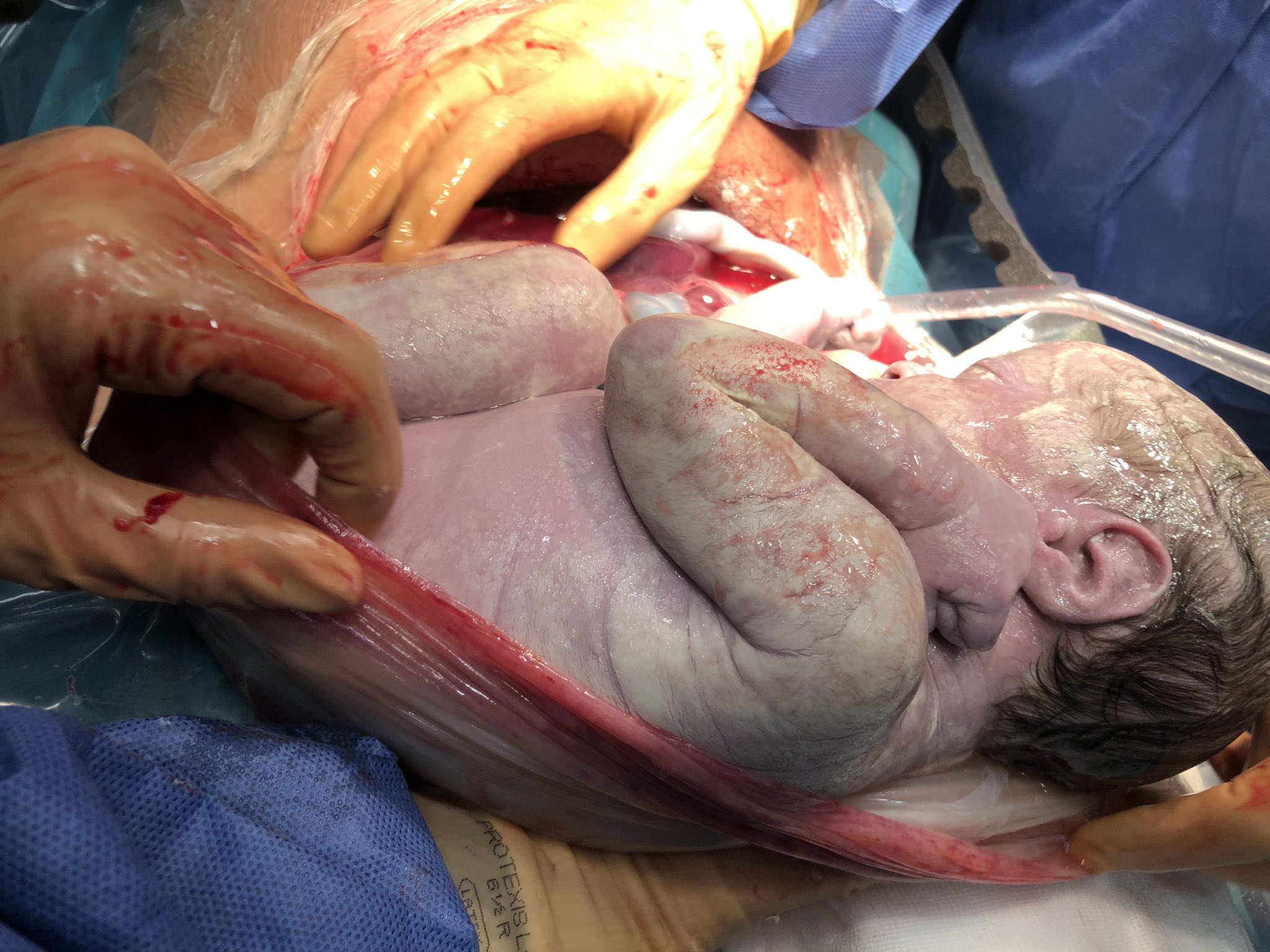 Τοκετός διδύμων: Συγκλονίζει η στιγμή που το ένα μωρό γεννιέται μέσα στον αμνιακό σάκο